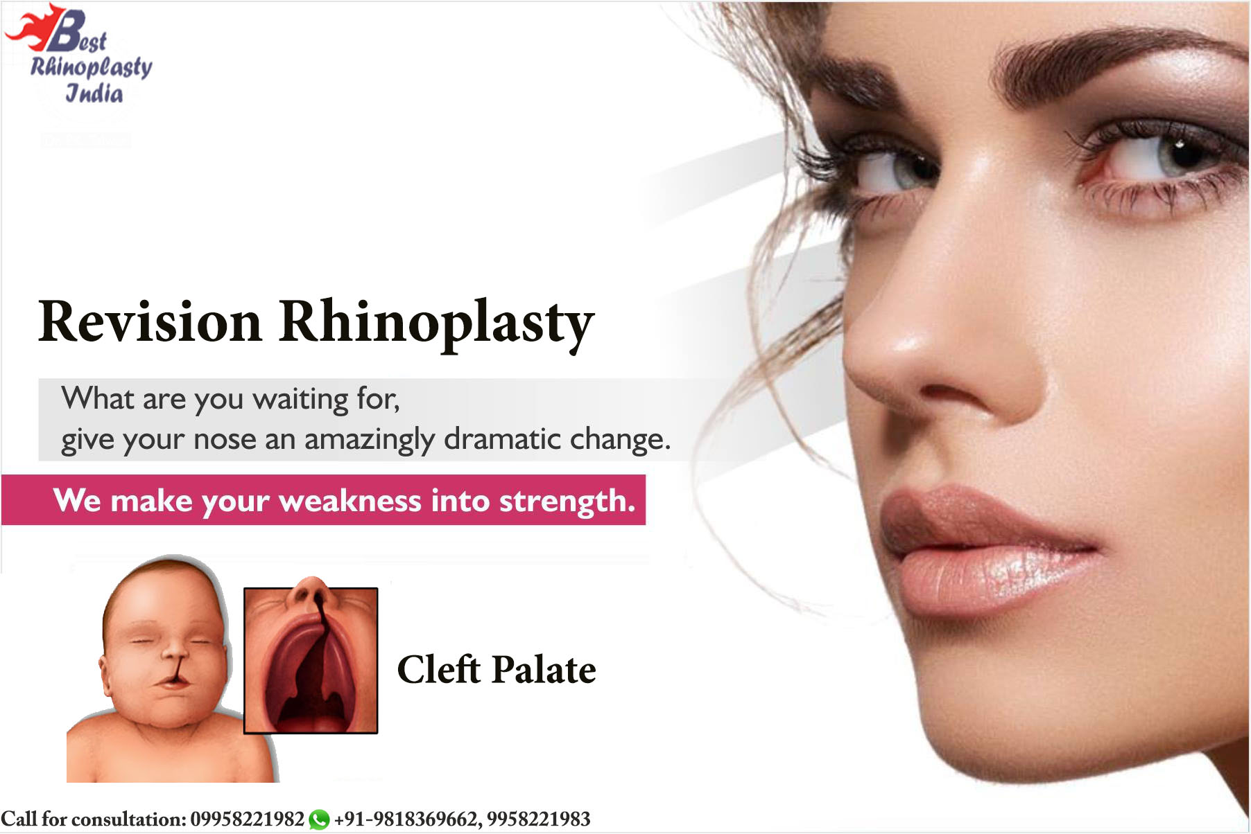 #rhinoplasty ,#rhinoplastycost, #rhinoplastyclinic, #nosesurgeon ,#nosejob, #bestnosesurgeon, #bestrhinoplastyindia, #cleftpalate